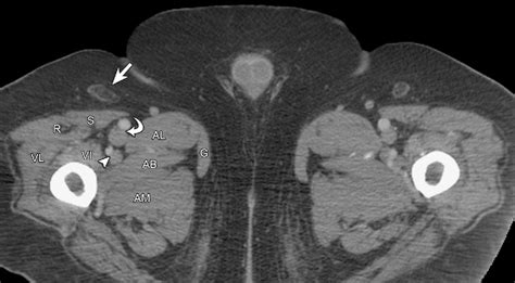 inguinal lymphadenopathy radiology